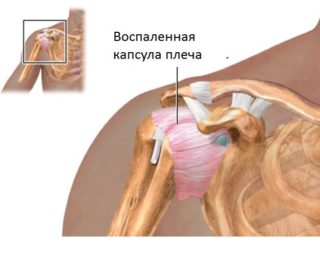 Боль в правой лопатке со стороны спины отдает в руку