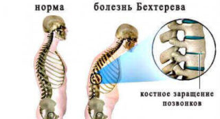 Болит косточка на спине в позвоночнике