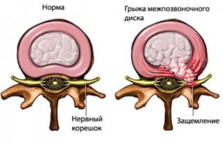 Нервы грудного и поясничного отдела