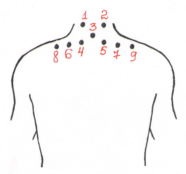 Гирудотерапия точки постановки пиявок схемы