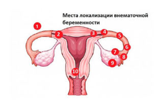 Болит поясница при месячных может ли быть беременность thumbnail