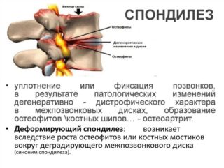 В позвоночнике человека срастаются позвонки