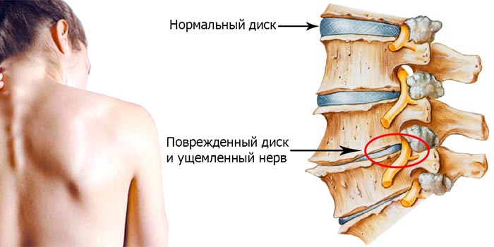 Картинки остеохондроза позвоночника