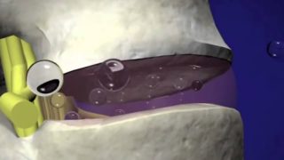 Гипогидратация дисков шейного отдела позвоночника