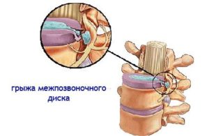 Введение плазмы в позвоночнике