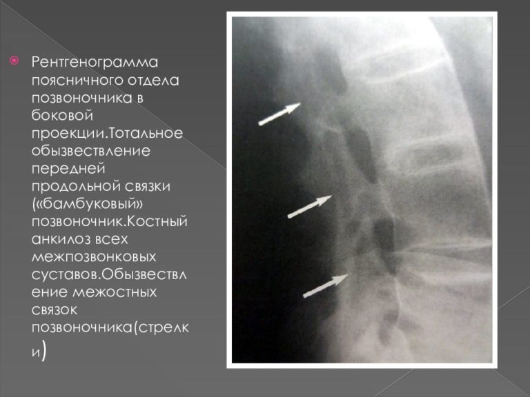 Рентген поясничного отдела позвоночника фото