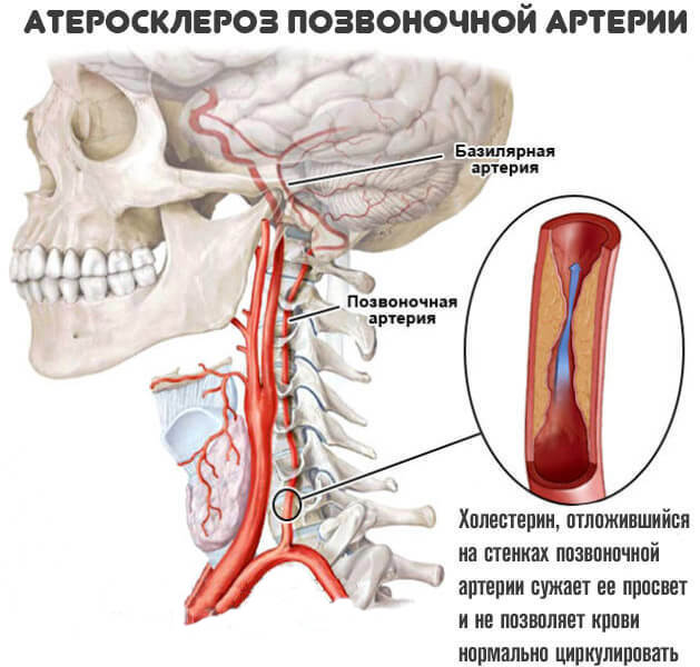 Вертебрально базилярная недостаточность. Аплазия позвоночной артерии. Гипоплазия правой позвоночной артерии сегменты. Гипоплазия лёвой позвоночной артерии. Гипоплазия v4 сегмента правой позвоночной артерии.