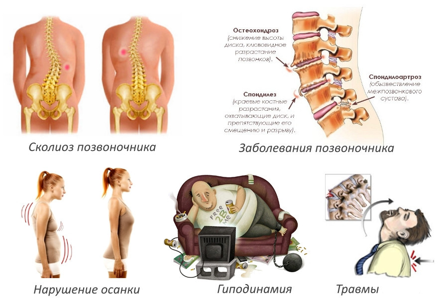 Схема лечения протрузии и грыжи поясничного отдела позвоночника