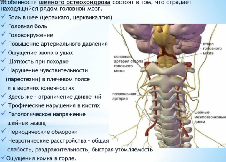 Что такое цервикокраниалгия на фоне шейного остеохондроза