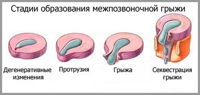 Протрузии шейного отдела фото