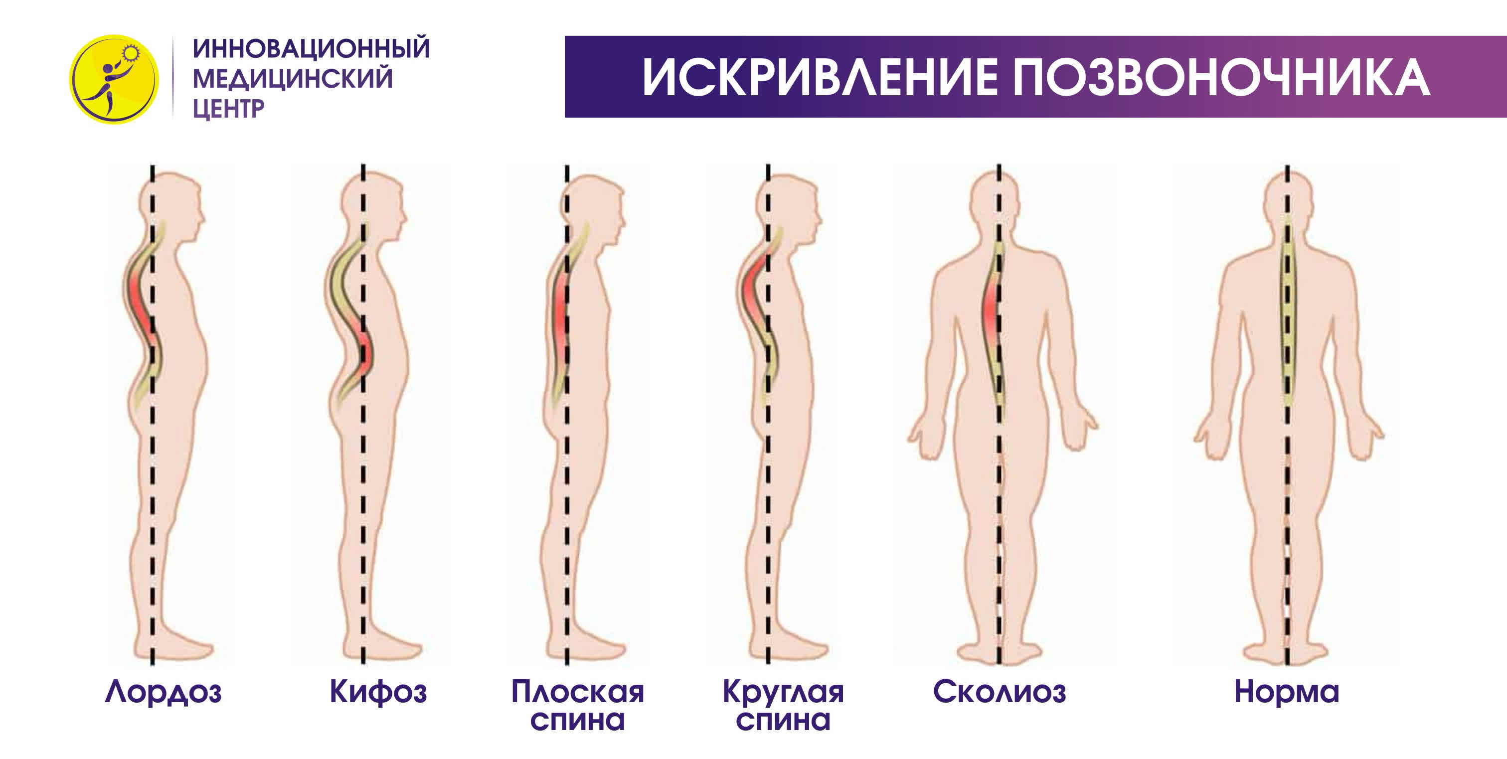 Лордоз и кифоз фото