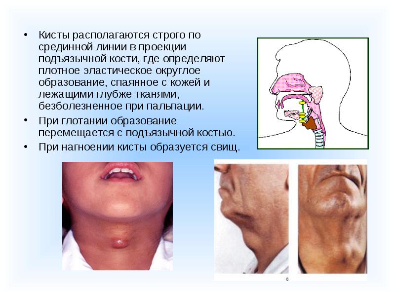 Подъязычная кость фото где находится