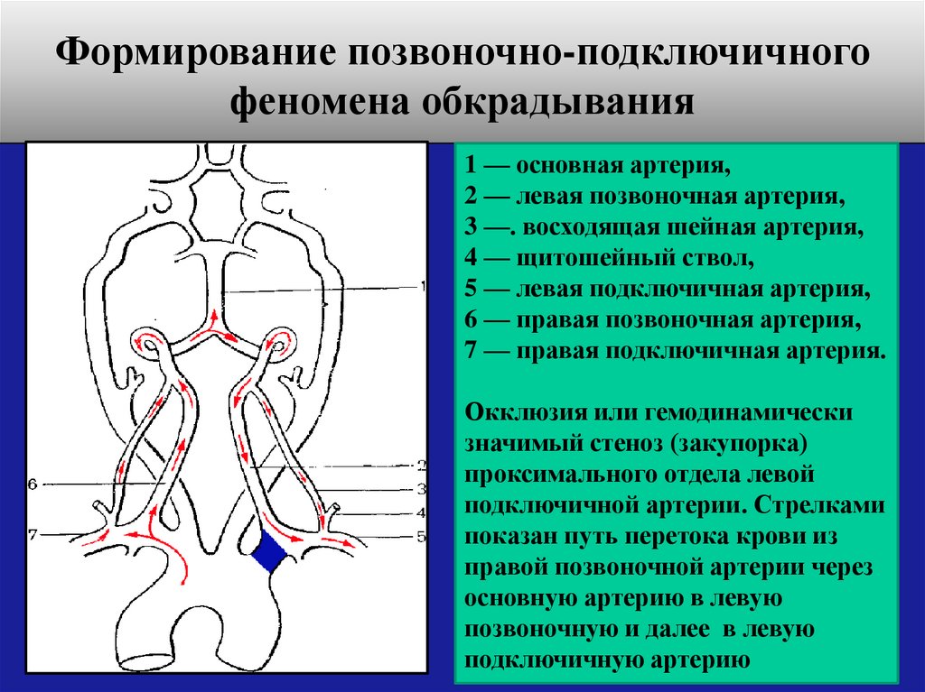 Сужение правой артерии. Левая подключичная артерия сегменты. Стеноз подключичной артерии кт. 2 Сегмент подключичной артерии. Синдром обкрадывания подключичной артерии на УЗИ.