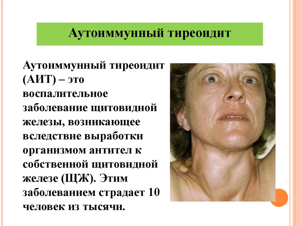 Тиреоидит dr md ru. Хронический аутоиммунный тиреоидит синдромы. Аутоиммунные заболевания щитовидной железы тиреоидит. Хронический аутоиммунный тиреоидит гипотиреоз щитовидной железы.