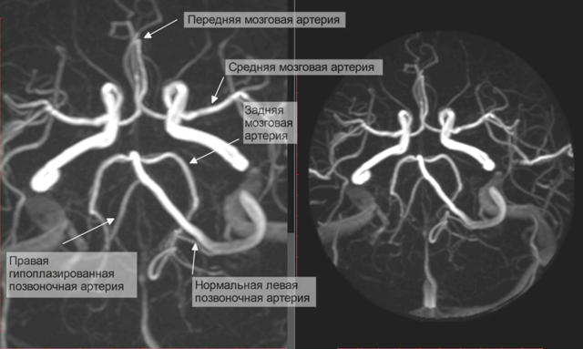 Виллизиев круг вариант развития на мрт. Сегменты средней мозговой артерии схема мрт. Сегменты передней мозговой артерии на кт. Сегменты средней мозговой артерии на кт. Сегменты передней мозговой артерии схема.