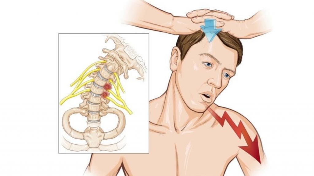 Шейная радикулопатия. Шейная радикулопатия симптомы. Радикулопатия шейного отдела симптомы.