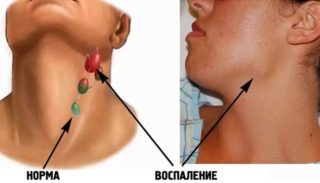 Болит горло и за ушами шея без температуры