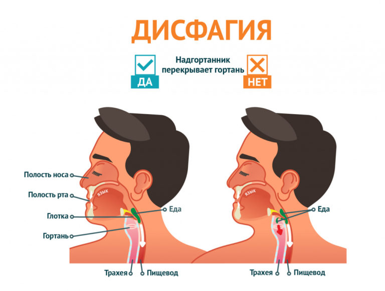 Болезни гортани фото и симптомы