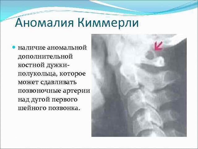 Лфк при синдроме позвоночной артерии на фоне остеохондроза