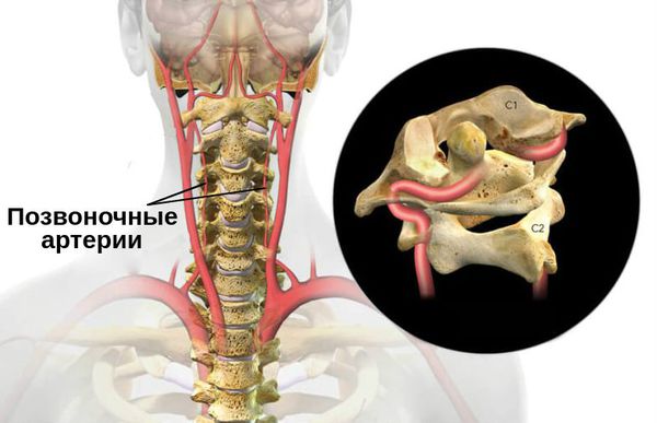 Синдром вертебральной артерии на фоне шейного остеохондроза симптомы лечение