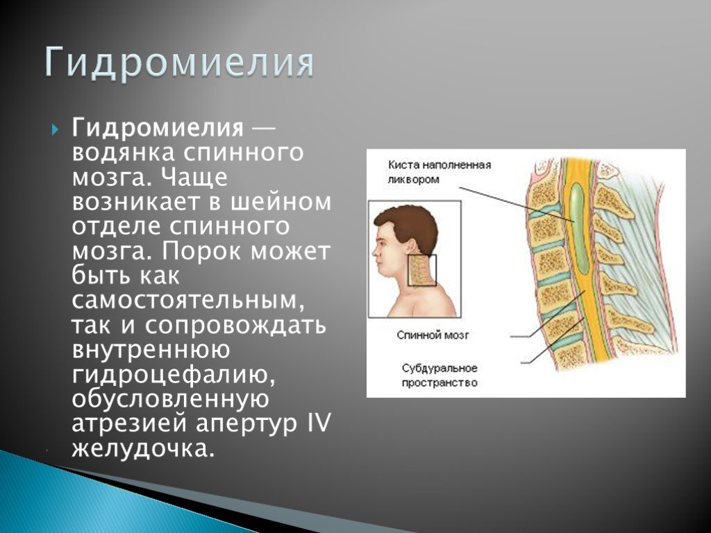 Фиксированный спинной. Гидромиелия сирингомиелия. Гидромиелия спинного мозга. Гидромиелия шейного отдела позвоночника. Гидросирингомиелия грудного отдела.