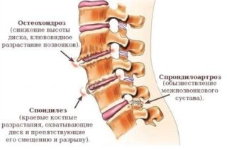 Надувной воротник для вытяжение позвоночника