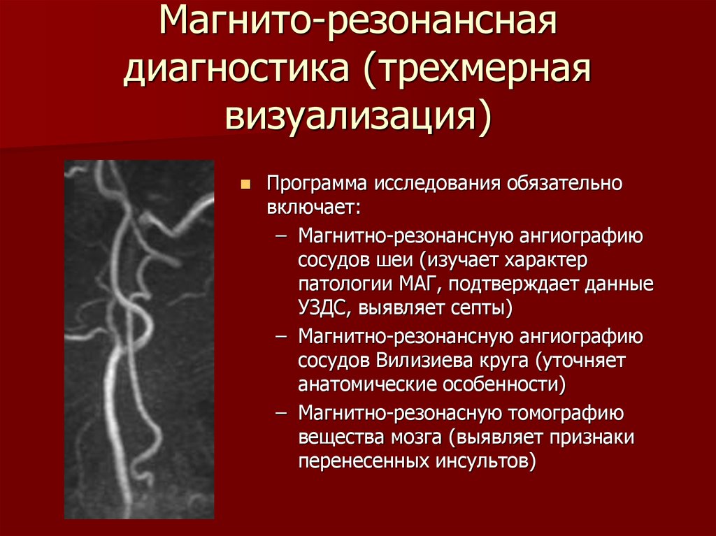 Изгиб вса. Гипоплазия правой позвоночной артерии на кт. Извитость позвоночной артерии. Патологическая извитость магистральных артерий. Патологическая извитость позвоночной артерии.