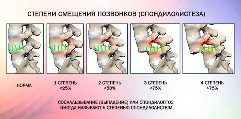 Антелистез l5 1 степени на фоне спондилолиза