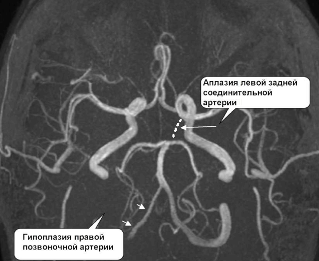 Мра картина асимметрии интракраниальных сегментов позвоночных артерий