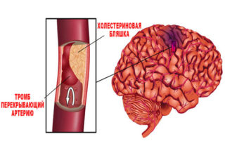 Ишемический инсульт после операции на сонной артерии