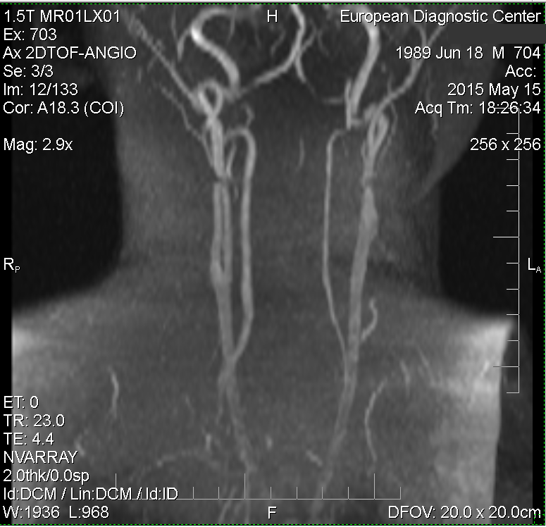 Гипоплазия правой артерии мозга. Мкб-10 гипоплазия позвоночной артерии слева. Гипоплазия v4 позвоночной артерии. Гипоплазия v4 сегмента левой позвоночной артерии. Аномалия позвоночной артерии врожденная.