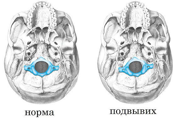 Смещение атланта у детей фото