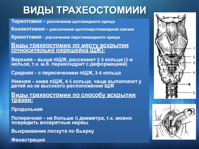 Трахеостомия техника выполнения в картинках для детей