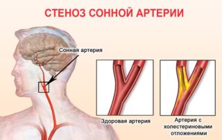 Сонная артерия на шее расположение с какой стороны фото у человека