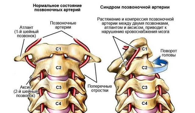 Позвоночные артерии картинки