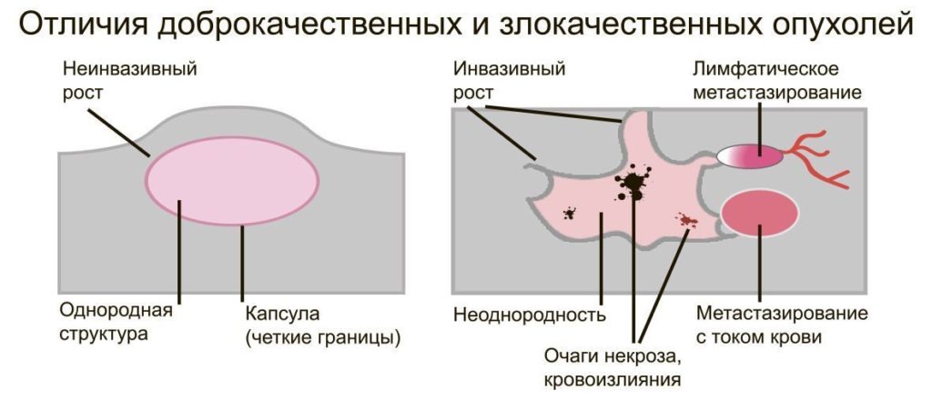 Злокачественная опухоль на шее фото