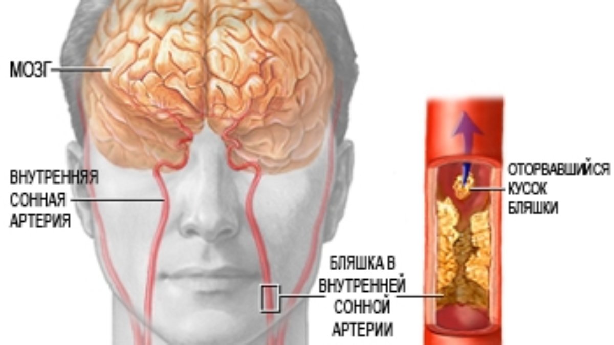 Бляшки в сосудах головы. Инсульт сонной артерии. Бляшки в сонной артерии шейного.