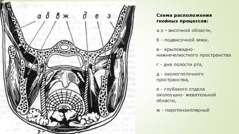 Абсцесс челюстно язычного желобка фото