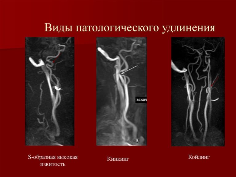 Цервикобрахиалгия слева на фоне шейного