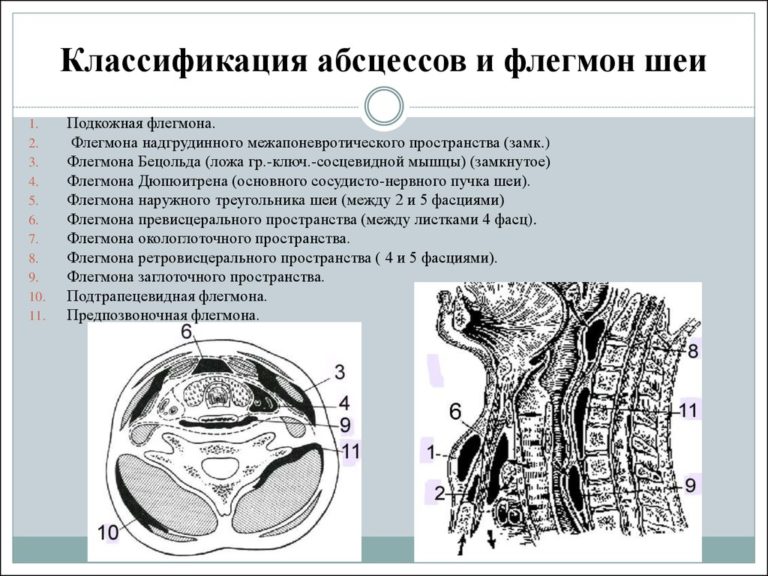 Абсцесс и флегмона фото