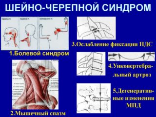 Шейно черепной синдром по мкб 10