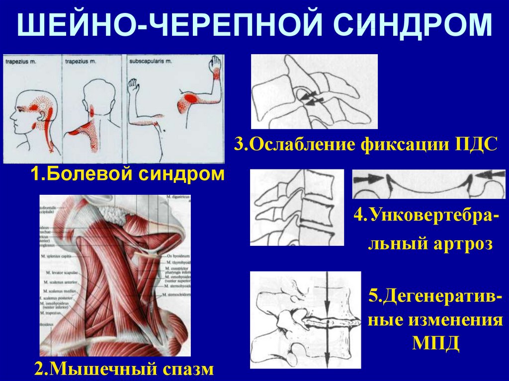 Синдром шейной артерии лечение. Шейно-черепной синдром. Мвшечно чнрепной синдром. Шейно-черепной синдром симптомы. Цервикокраниалгия шейно черепной синдром.