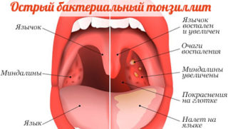 Миндалины глоточного кольца: строение и функции, указание места ...