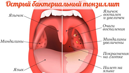 Гланды и миндалины фото