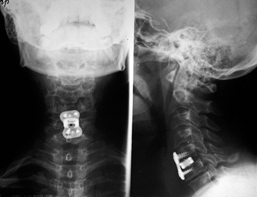 Рентгеновские пластины. Пластина Vectra для шейного спондилодеза. Подвывих с6 позвонка рентген. Передний спондилодез Кейджем с5-с6. Передний корпородез с5 с6 Кейджем Solis.