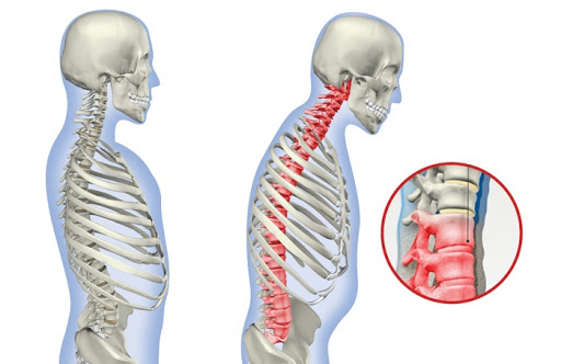 Кифоз шейного отдела фото