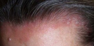 Красная кожа головы и выпадение волос причины