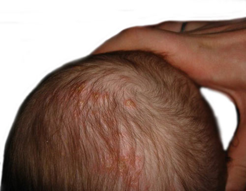 Псориаз на голове у ребенка фото лечение