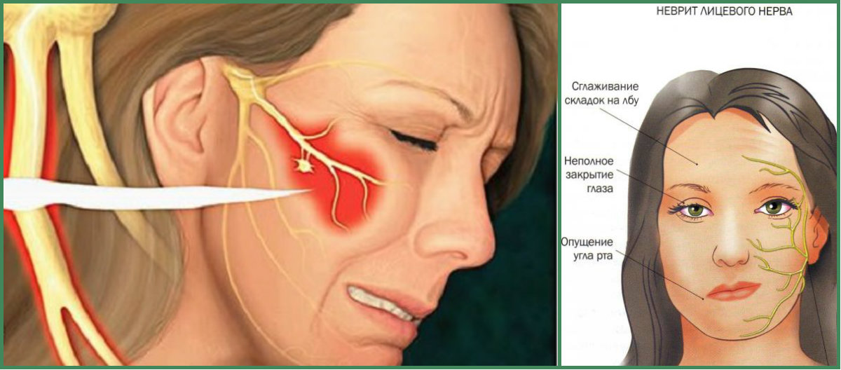 Воспаление тройничного нерва на лице симптомы и лечение в домашних условиях фото