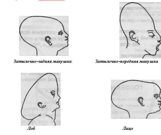 Правильная форма черепа у младенца. Форма черепа у детей в норме. Виды формы головы новорожденных. Форма головы у новорожденных норма при головном предлежании.